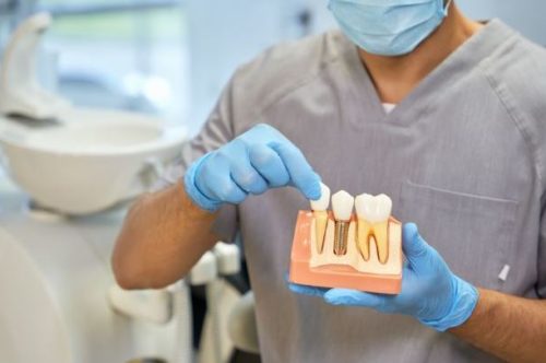 dental_implants_Amherst_Village_Dental