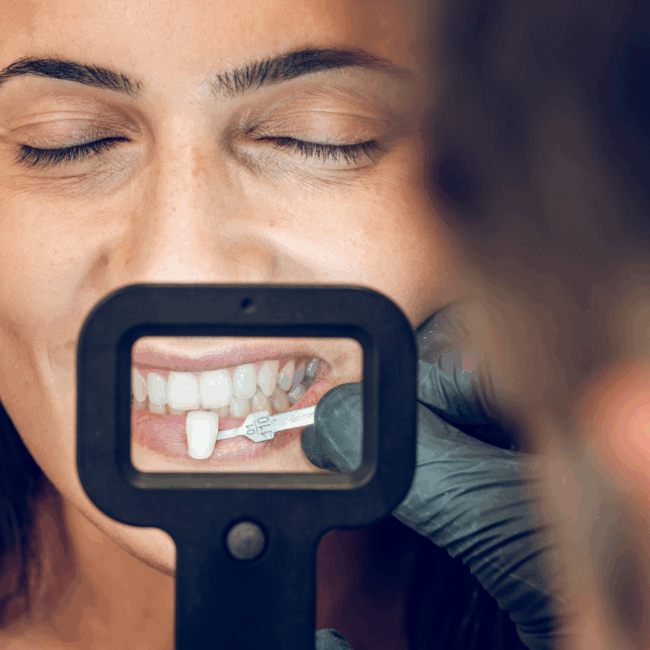 dental_veneers_Amherst_Village_dentist