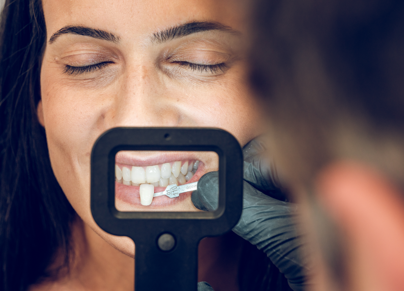 dental_veneers_Amherst_Village_dentist